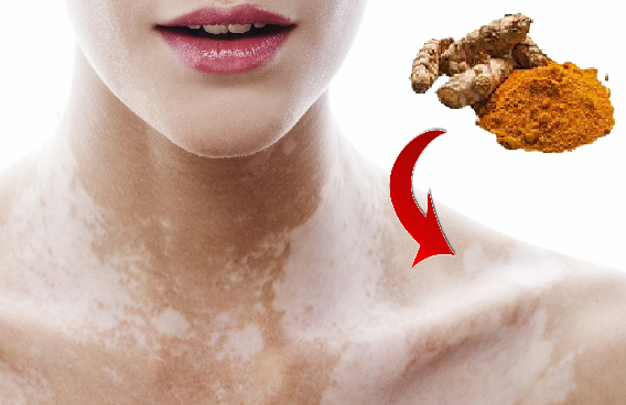 Tratamiento natural para el vitiligo