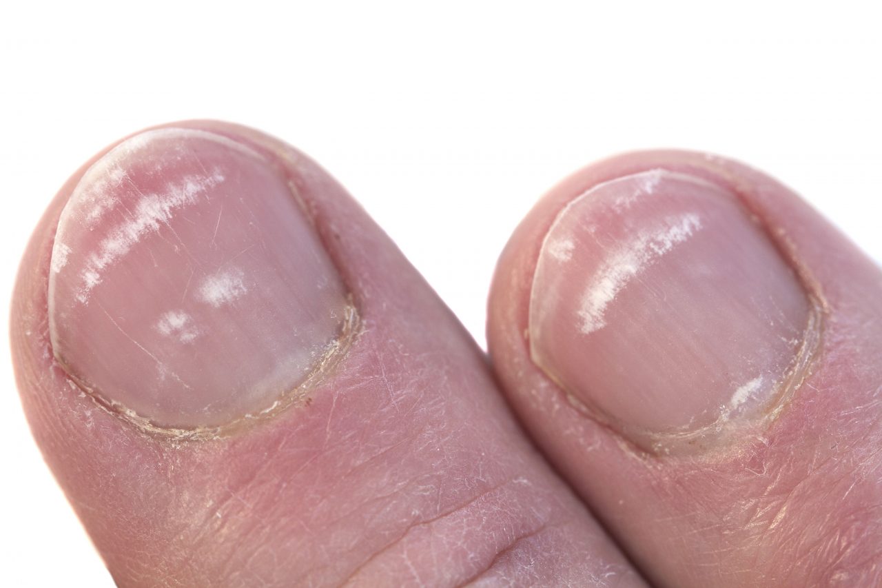 Uñas moradas de los pies